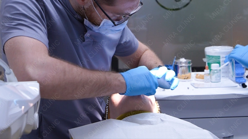 Hollywood smile Final Fitting